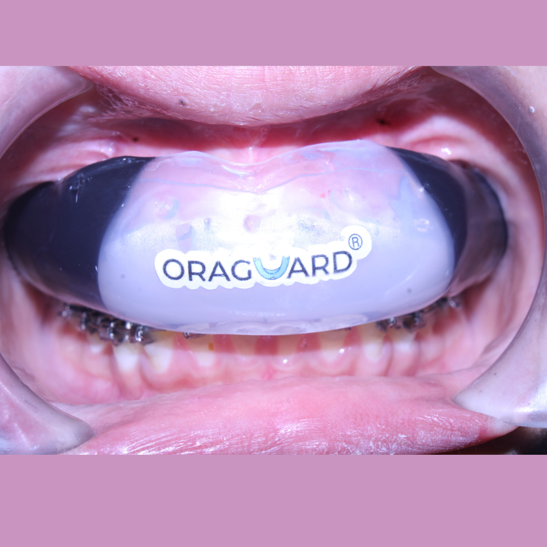 ORAGUARD® BRACESAFE